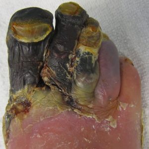 Diabetes caused Rotting Foot